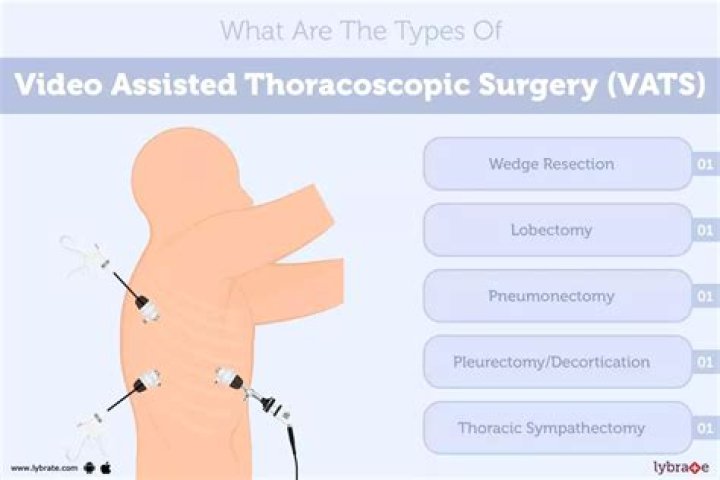 Is VATS considered major surgery?
