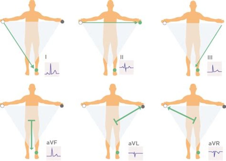 What does RA stand for ECG?
