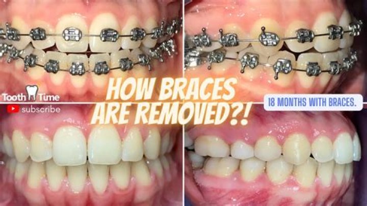 What to do for someone who just got braces?