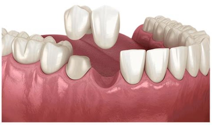 Which dental bridge is best?