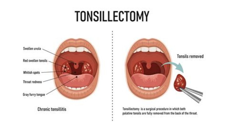 Why do tonsils get removed?